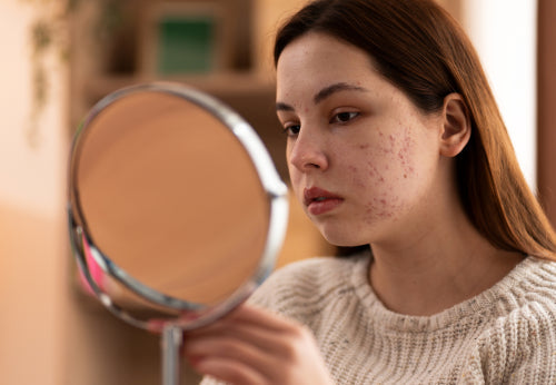 The Link Between Stress and Skin Breakouts